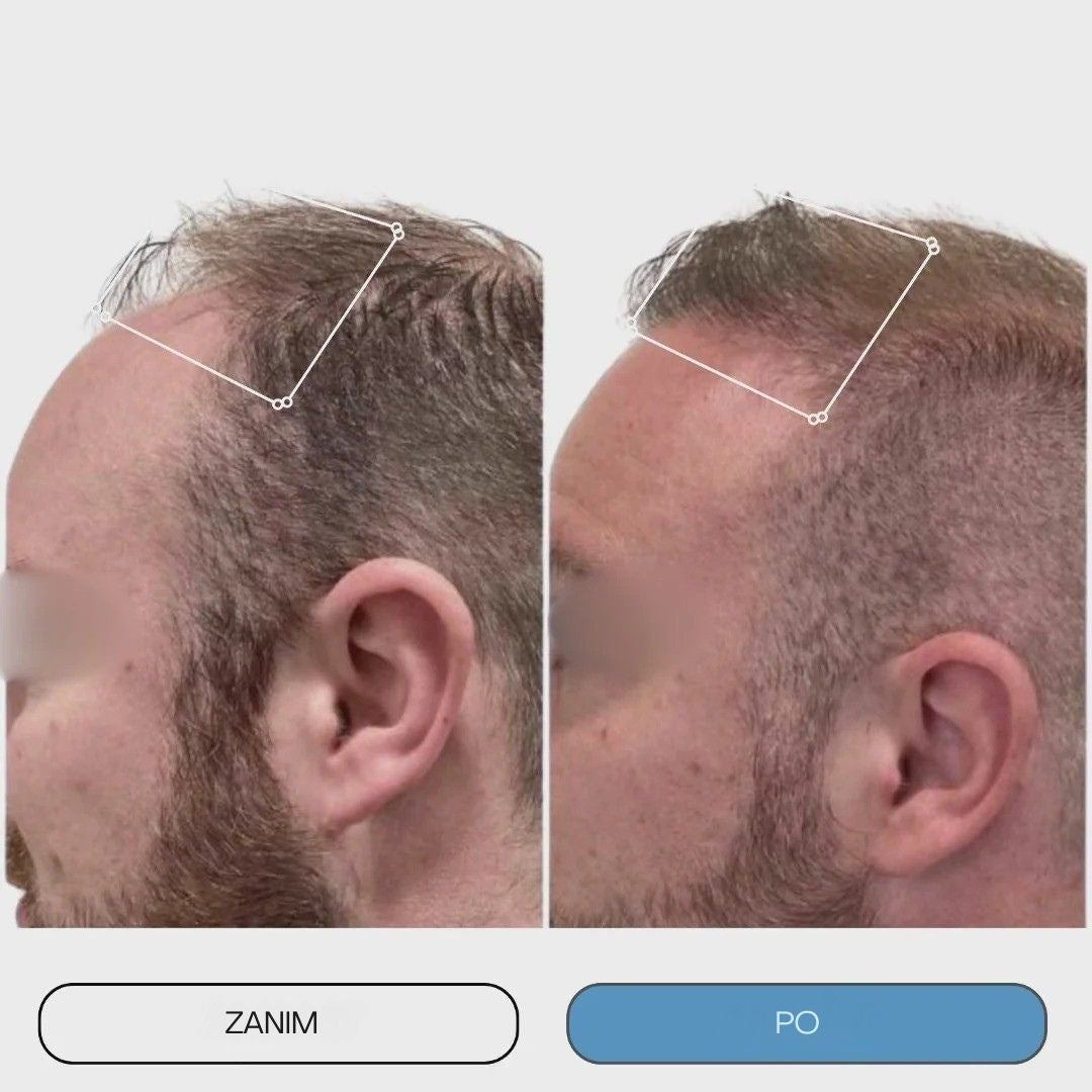 Tehnologia microacupuncturii pentru păr