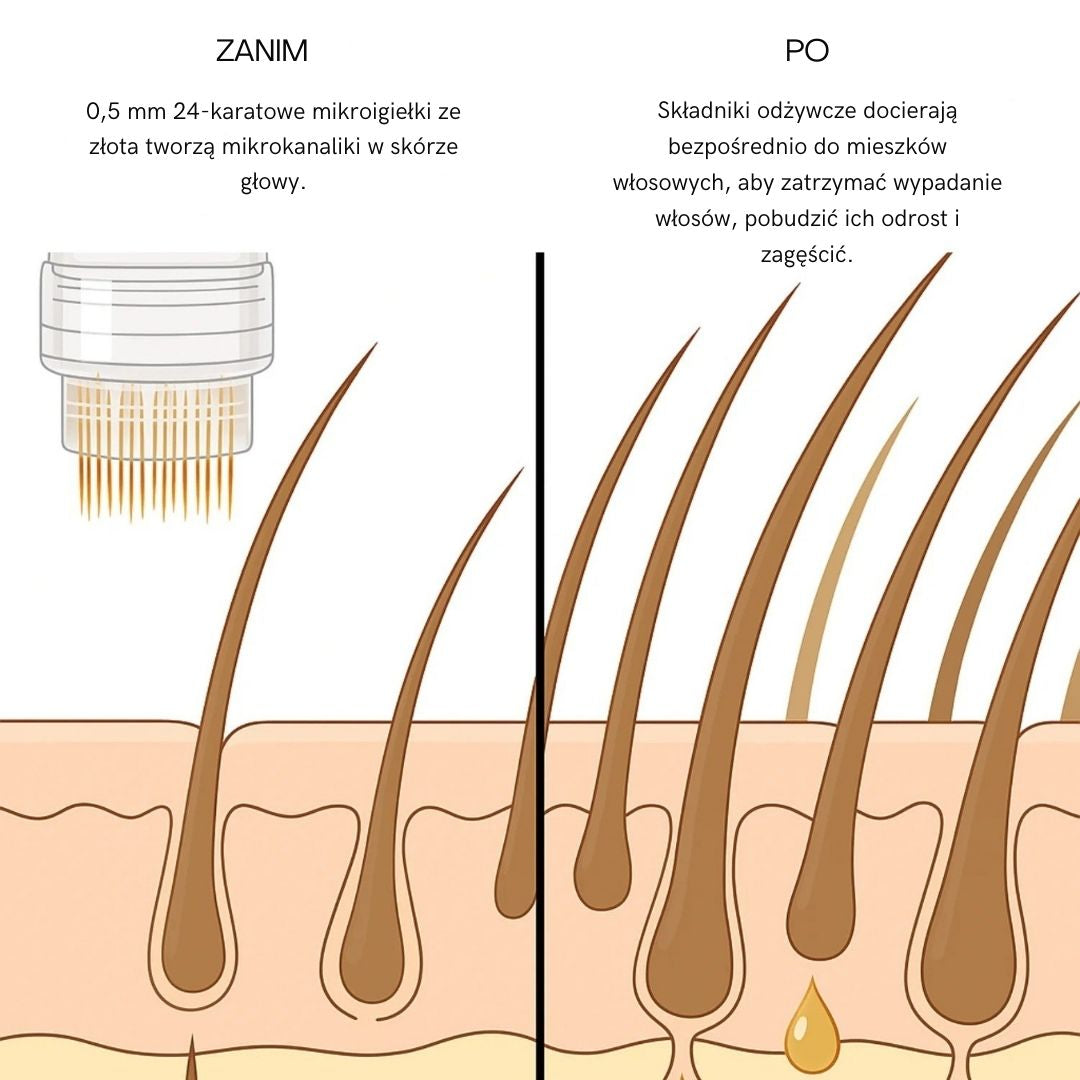 Tehnologia microacupuncturii pentru păr